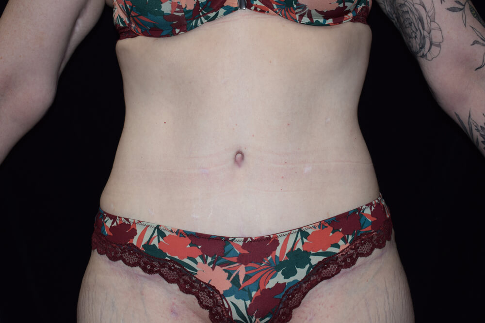 Tummy Tuck (abdominoplasty) - Dr. Joseph A. Racanelli Tummy Tuck (abdominoplasty)