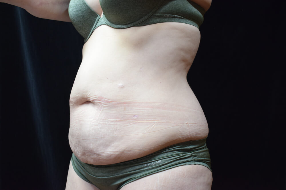 Tummy Tuck (abdominoplasty) - Dr. Joseph A. Racanelli Tummy Tuck (abdominoplasty)