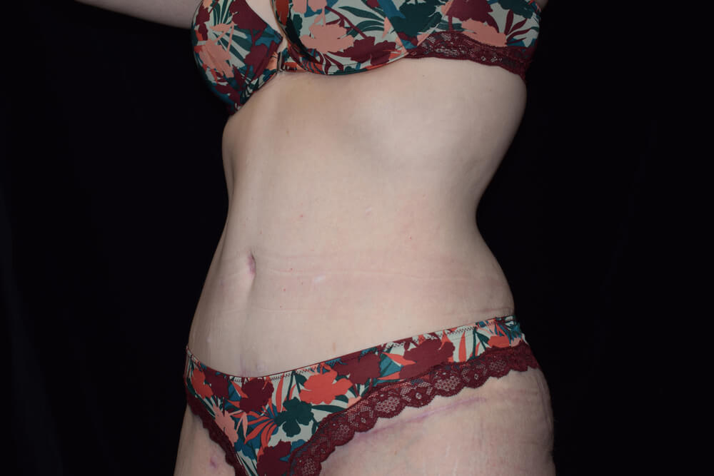 Tummy Tuck (abdominoplasty) - Dr. Joseph A. Racanelli Tummy Tuck (abdominoplasty)