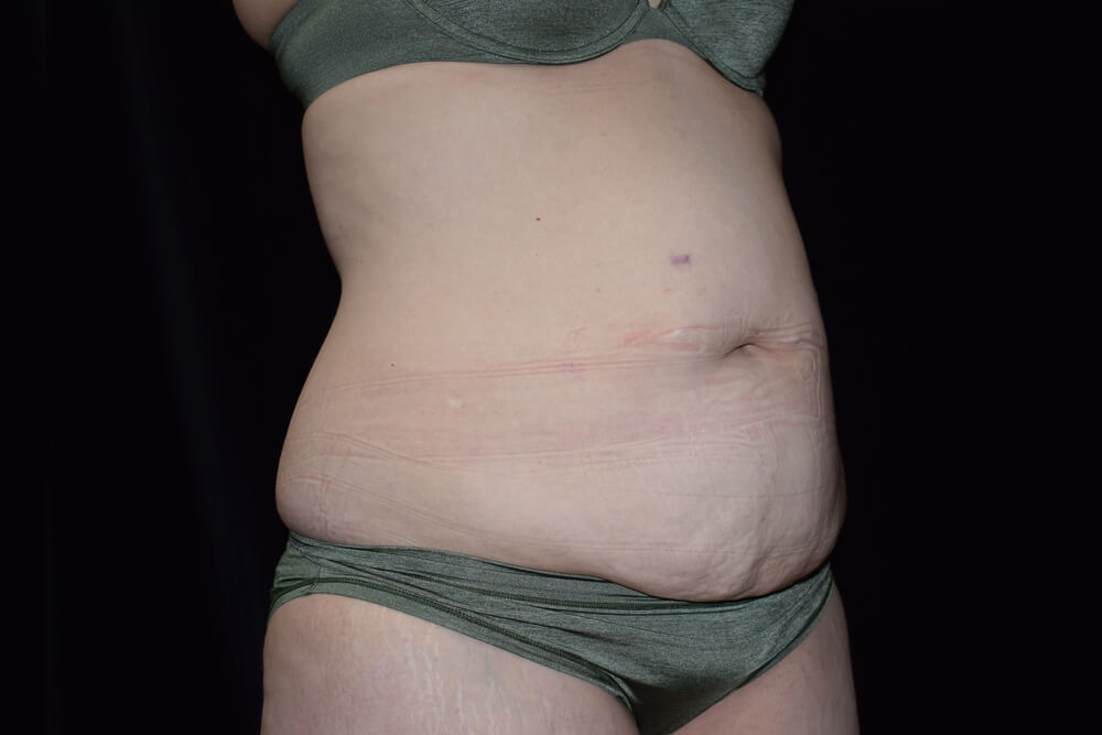 Tummy Tuck (abdominoplasty) - Dr. Joseph A. Racanelli Tummy Tuck (abdominoplasty)