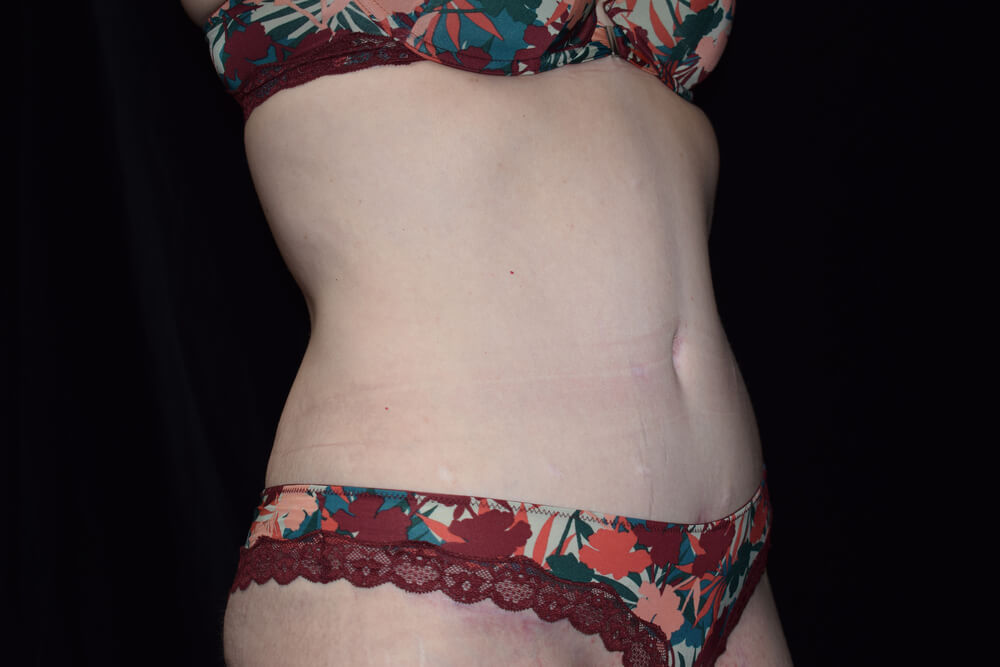 Tummy Tuck (abdominoplasty) - Dr. Joseph A. Racanelli Tummy Tuck (abdominoplasty)