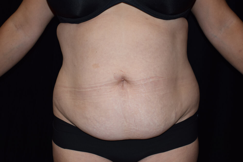 Tummy Tuck (abdominoplasty) - Dr. Joseph A. Racanelli Tummy Tuck (abdominoplasty)