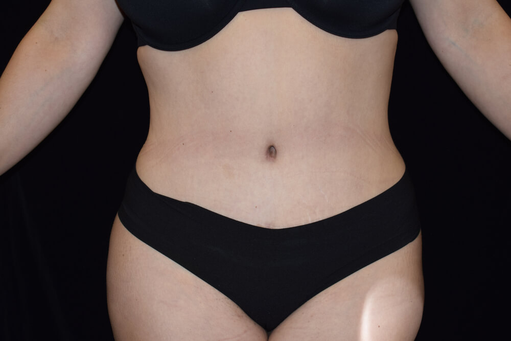 Tummy Tuck (abdominoplasty) - Dr. Joseph A. Racanelli Tummy Tuck (abdominoplasty)