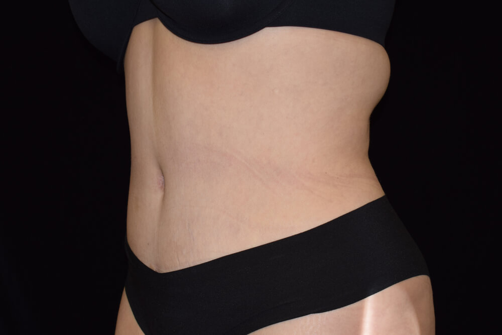 Tummy Tuck (abdominoplasty) - Dr. Joseph A. Racanelli Tummy Tuck (abdominoplasty)