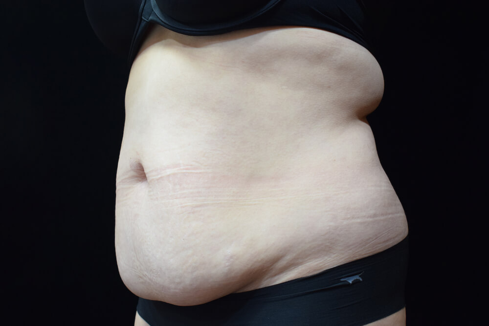 Tummy Tuck (abdominoplasty) - Dr. Joseph A. Racanelli Tummy Tuck (abdominoplasty)