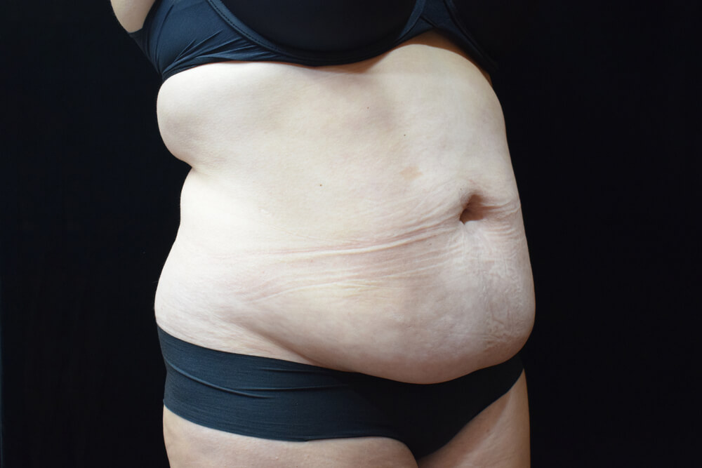 Tummy Tuck (abdominoplasty) - Dr. Joseph A. Racanelli Tummy Tuck (abdominoplasty)