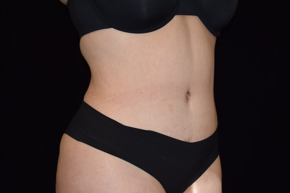 Tummy Tuck (abdominoplasty) - Dr. Joseph A. Racanelli Tummy Tuck (abdominoplasty)