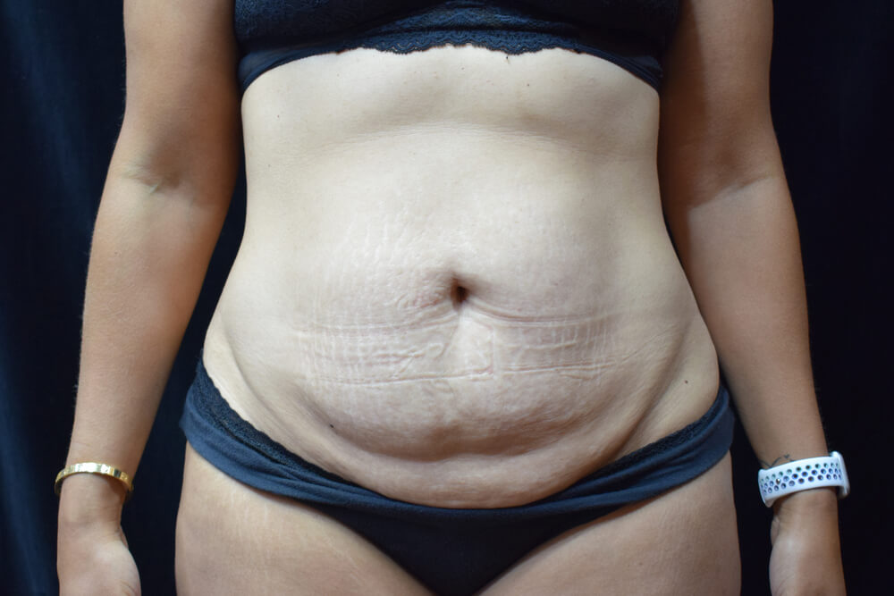 Tummy Tuck (abdominoplasty) - Dr. Joseph A. Racanelli Tummy Tuck (abdominoplasty)