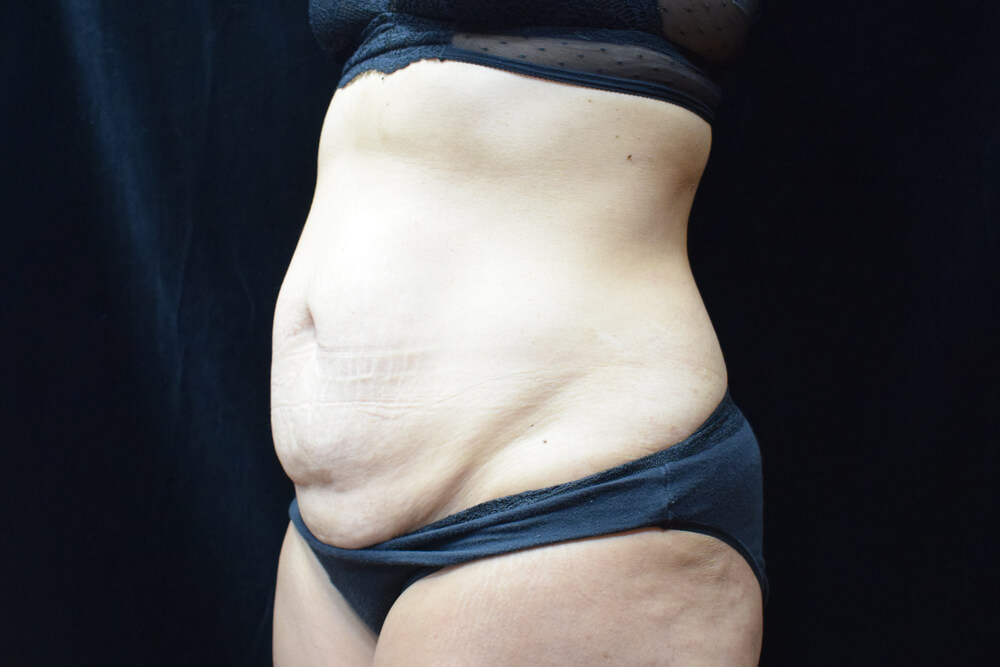 Tummy Tuck (abdominoplasty) - Dr. Joseph A. Racanelli Tummy Tuck (abdominoplasty)