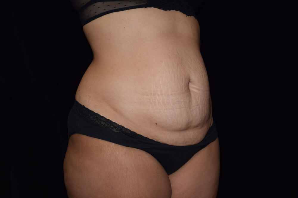 Tummy Tuck (abdominoplasty) - Dr. Joseph A. Racanelli Tummy Tuck (abdominoplasty)