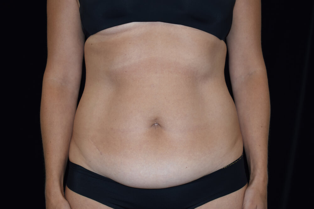 Tummy Tuck (abdominoplasty) - Dr. Joseph A. Racanelli Tummy Tuck (abdominoplasty)