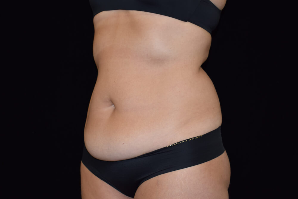 Tummy Tuck (abdominoplasty) - Dr. Joseph A. Racanelli Tummy Tuck (abdominoplasty)