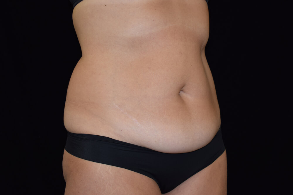 Tummy Tuck (abdominoplasty) - Dr. Joseph A. Racanelli Tummy Tuck (abdominoplasty)