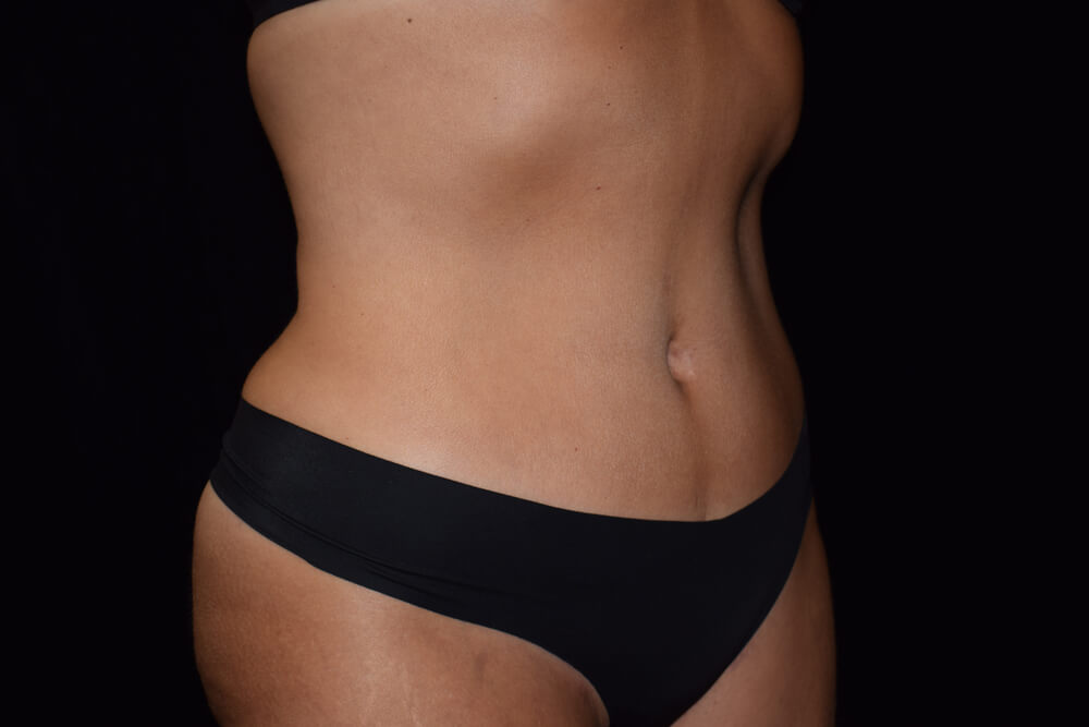 Tummy Tuck (abdominoplasty) - Dr. Joseph A. Racanelli Tummy Tuck (abdominoplasty)