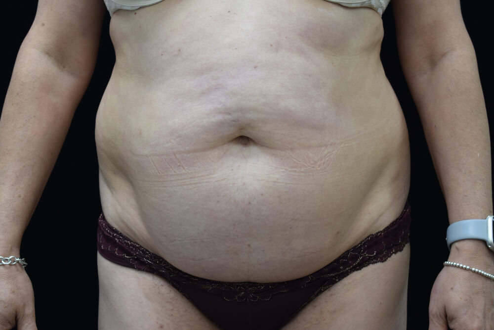 Tummy Tuck (abdominoplasty) - Dr. Joseph A. Racanelli Tummy Tuck (abdominoplasty)