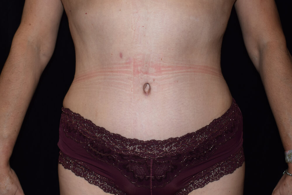 Tummy Tuck (abdominoplasty) - Dr. Joseph A. Racanelli Tummy Tuck (abdominoplasty)