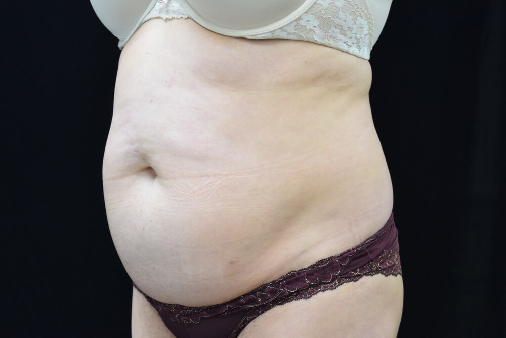 Tummy Tuck (abdominoplasty) - Dr. Joseph A. Racanelli Tummy Tuck (abdominoplasty)