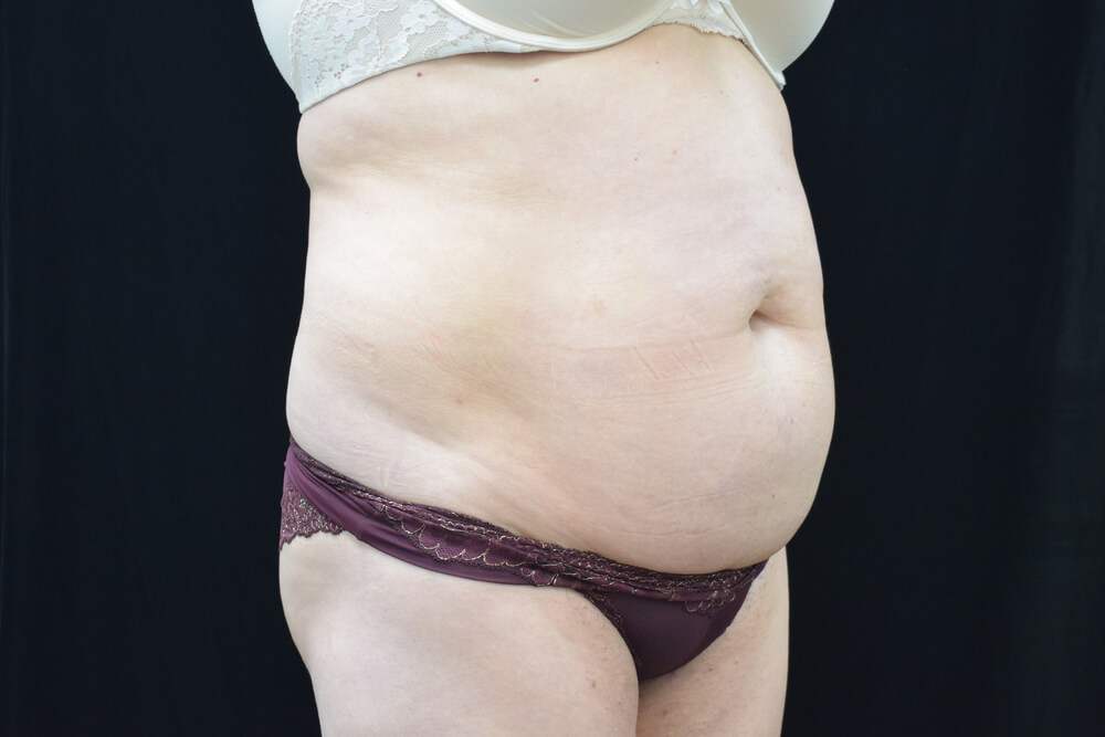 Tummy Tuck (abdominoplasty) - Dr. Joseph A. Racanelli Tummy Tuck (abdominoplasty)