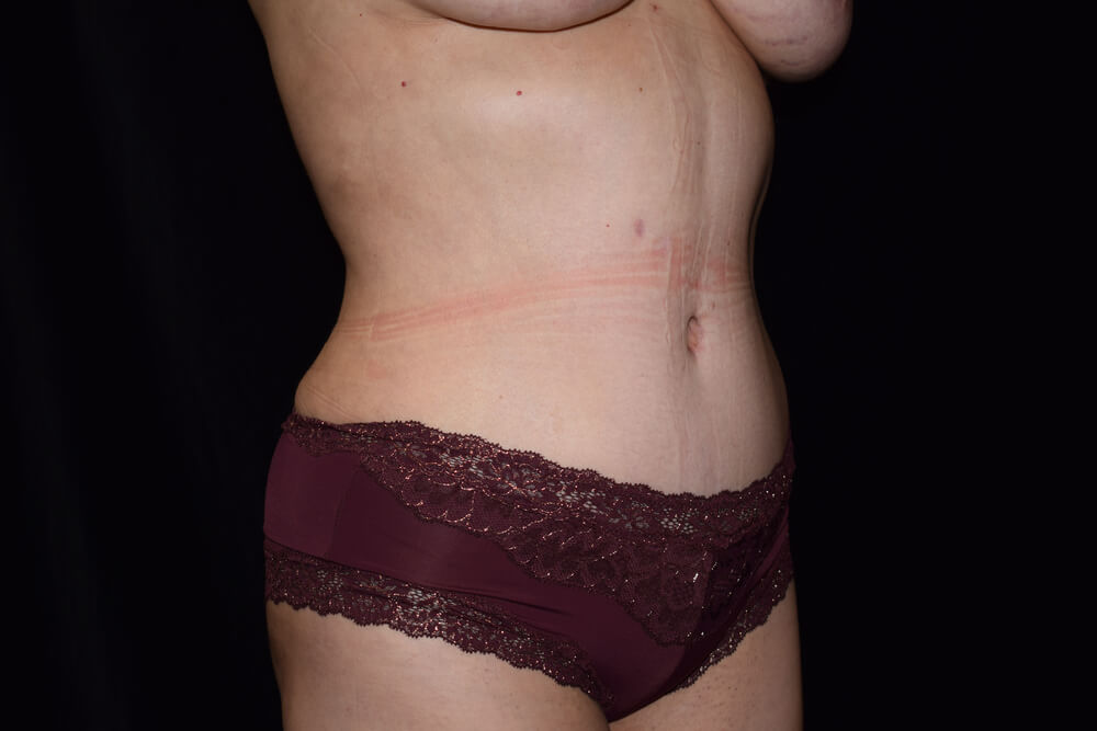 Tummy Tuck (abdominoplasty) - Dr. Joseph A. Racanelli Tummy Tuck (abdominoplasty)