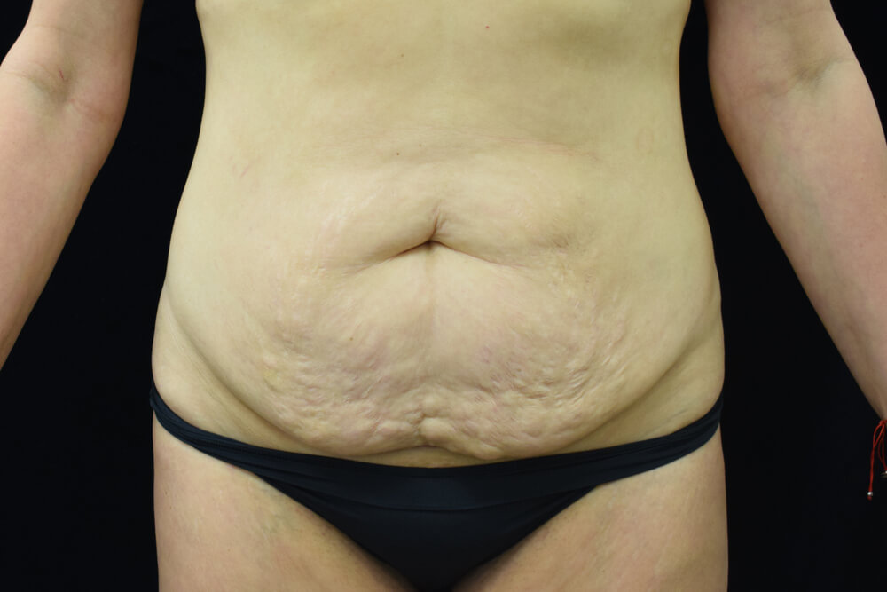Tummy Tuck (abdominoplasty) - Dr. Joseph A. Racanelli Tummy Tuck (abdominoplasty)