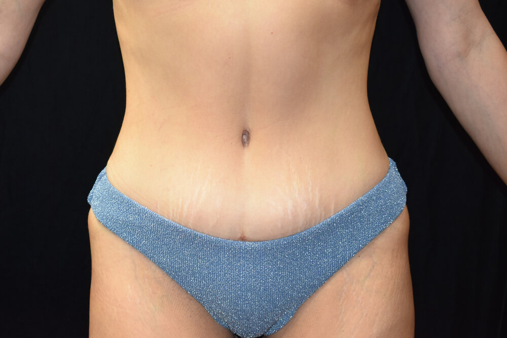 Tummy Tuck (abdominoplasty) - Dr. Joseph A. Racanelli Tummy Tuck (abdominoplasty)