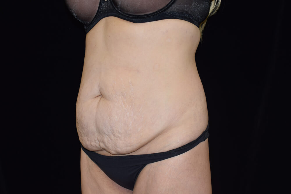 Tummy Tuck (abdominoplasty) - Dr. Joseph A. Racanelli Tummy Tuck (abdominoplasty)