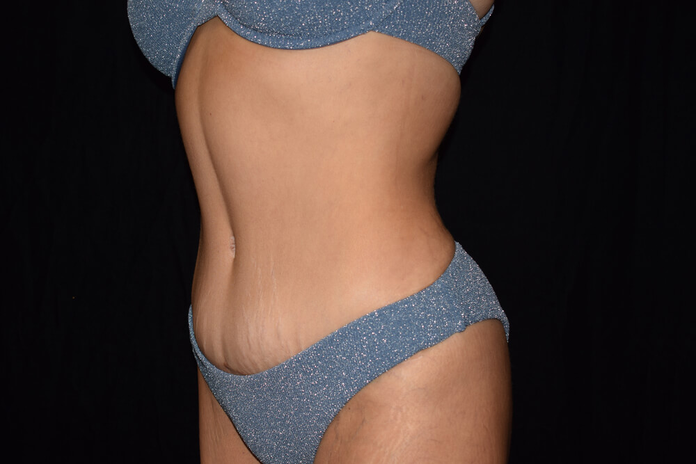 Tummy Tuck (abdominoplasty) - Dr. Joseph A. Racanelli Tummy Tuck (abdominoplasty)