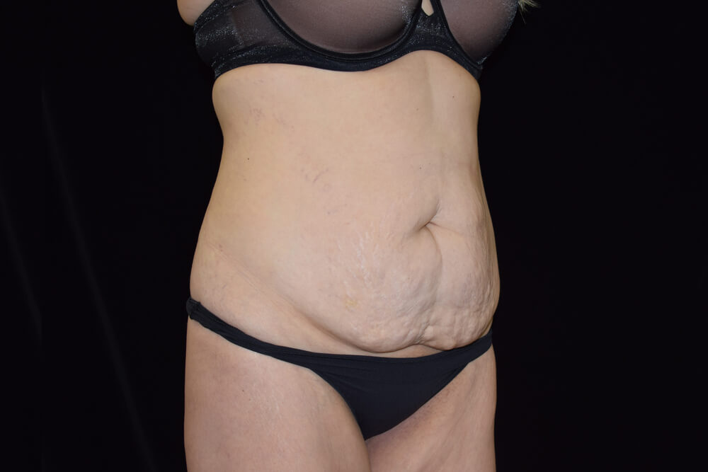 Tummy Tuck (abdominoplasty) - Dr. Joseph A. Racanelli Tummy Tuck (abdominoplasty)