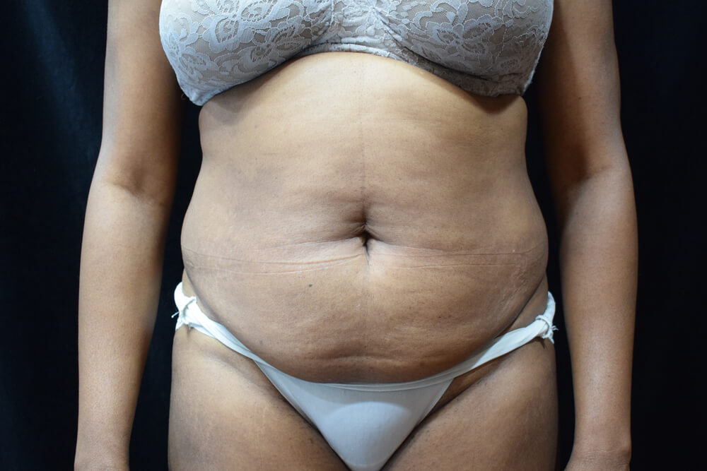 Tummy Tuck (abdominoplasty) - Dr. Joseph A. Racanelli Tummy Tuck (abdominoplasty)