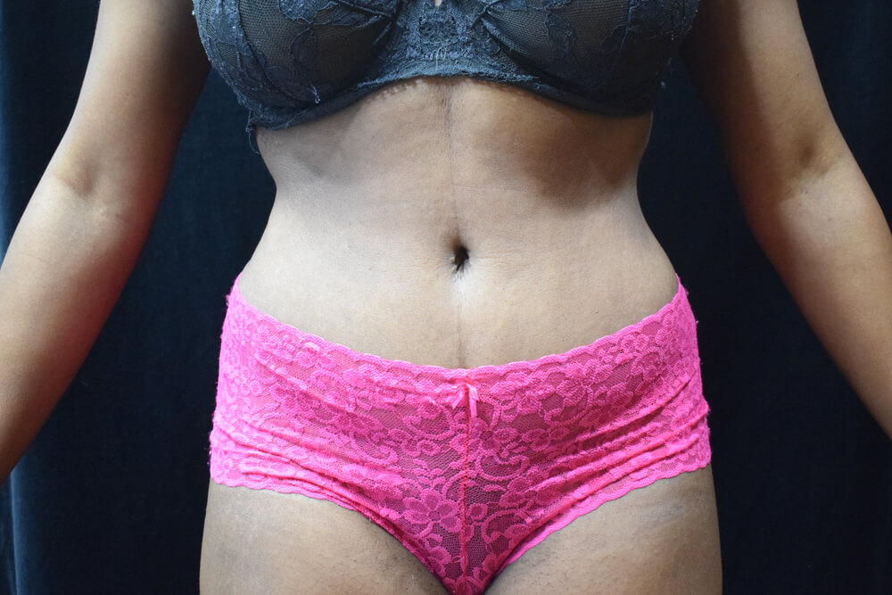 Tummy Tuck (abdominoplasty) - Dr. Joseph A. Racanelli Tummy Tuck (abdominoplasty)