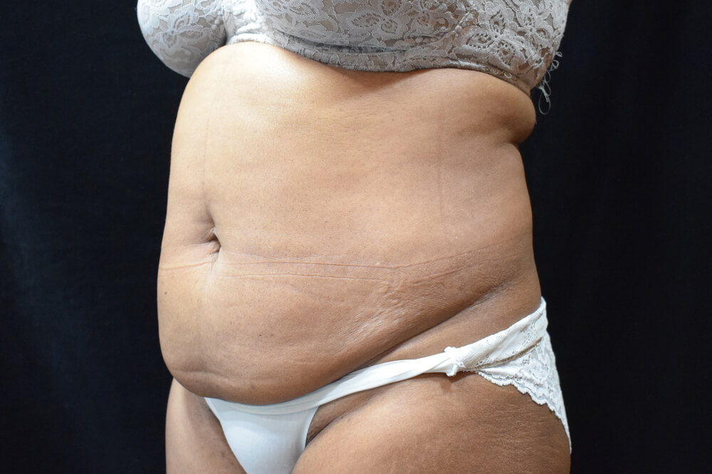 Tummy Tuck (abdominoplasty) - Dr. Joseph A. Racanelli Tummy Tuck (abdominoplasty)