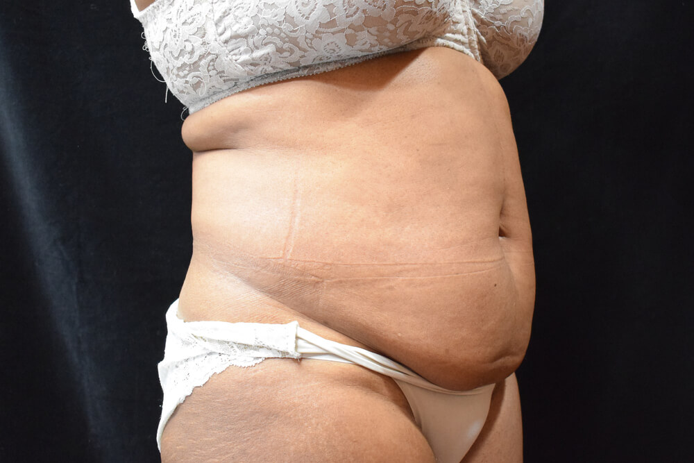 Tummy Tuck (abdominoplasty) - Dr. Joseph A. Racanelli Tummy Tuck (abdominoplasty)