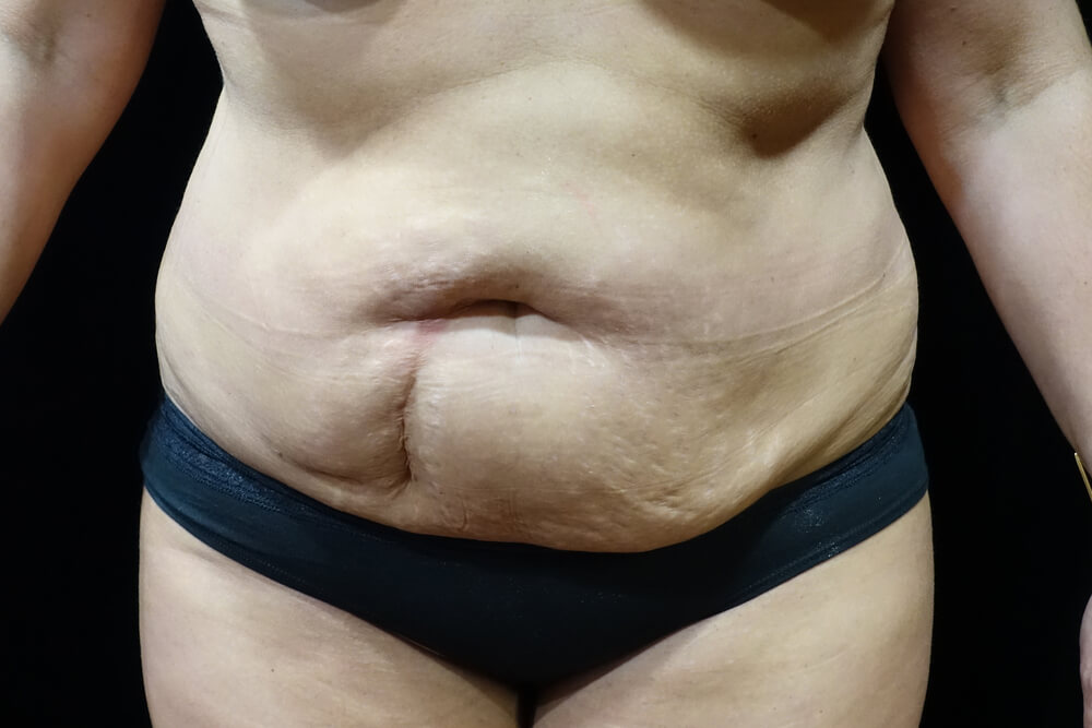 Tummy Tuck (abdominoplasty) - Dr. Joseph A. Racanelli Tummy Tuck (abdominoplasty)