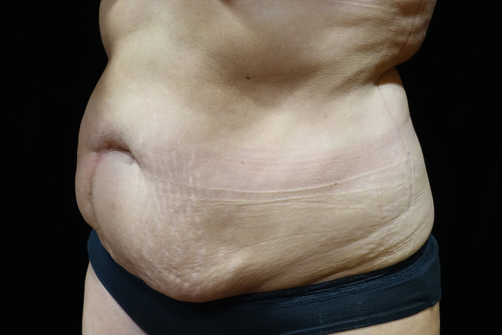 Tummy Tuck (abdominoplasty) - Dr. Joseph A. Racanelli Tummy Tuck (abdominoplasty)