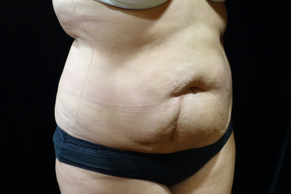 Tummy Tuck (abdominoplasty) - Dr. Joseph A. Racanelli Tummy Tuck (abdominoplasty)