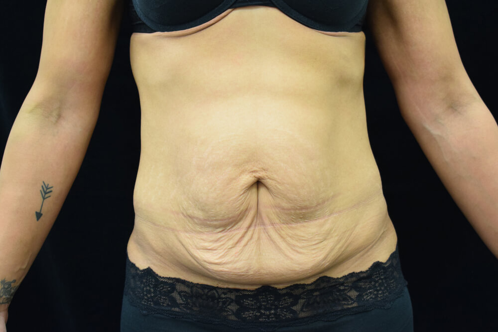 Tummy Tuck (abdominoplasty) - Dr. Joseph A. Racanelli Tummy Tuck (abdominoplasty)