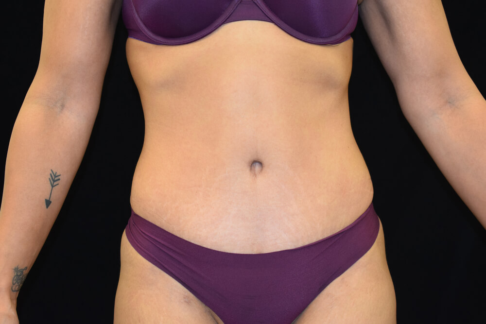 Tummy Tuck (abdominoplasty) - Dr. Joseph A. Racanelli Tummy Tuck (abdominoplasty)