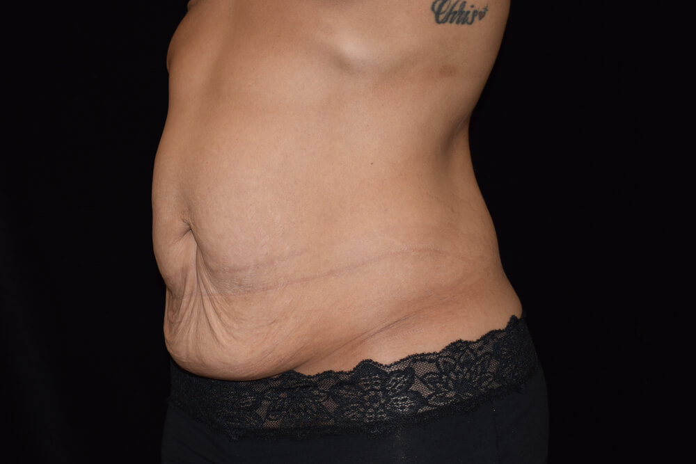 Tummy Tuck (abdominoplasty) - Dr. Joseph A. Racanelli Tummy Tuck (abdominoplasty)