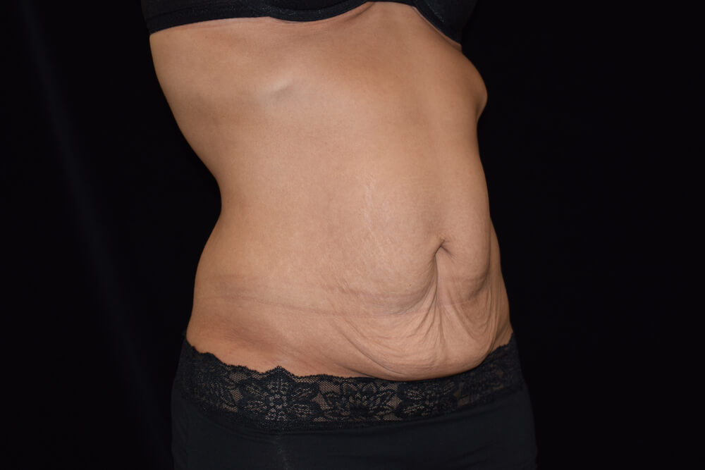 Tummy Tuck (abdominoplasty) - Dr. Joseph A. Racanelli Tummy Tuck (abdominoplasty)