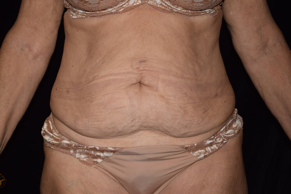 Tummy Tuck (abdominoplasty) - Dr. Joseph A. Racanelli Tummy Tuck (abdominoplasty)