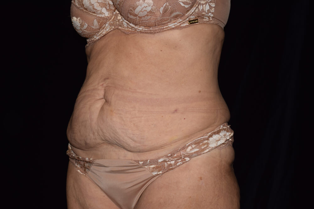 Tummy Tuck (abdominoplasty) - Dr. Joseph A. Racanelli Tummy Tuck (abdominoplasty)