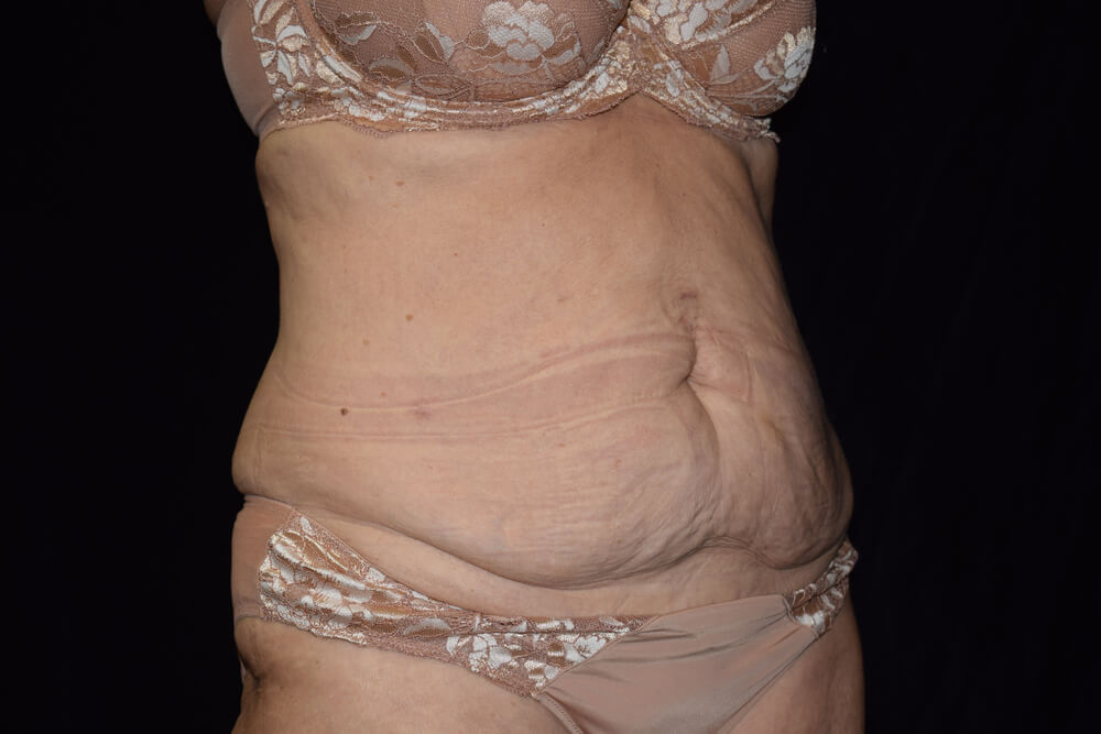Tummy Tuck (abdominoplasty) - Dr. Joseph A. Racanelli Tummy Tuck (abdominoplasty)