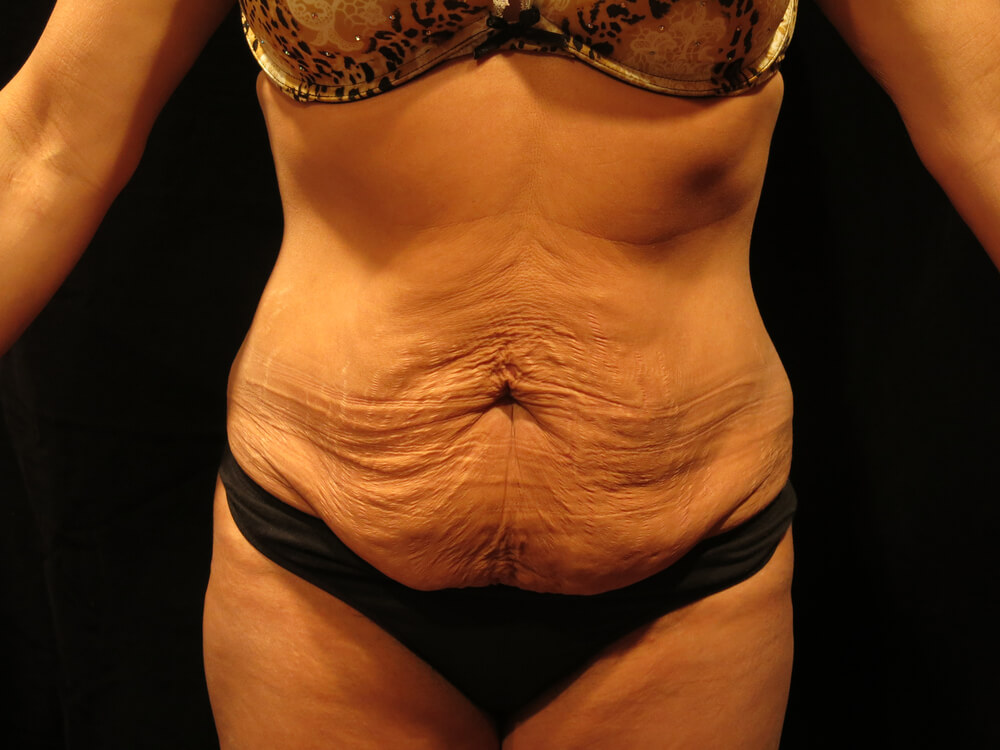 Tummy Tuck (abdominoplasty) - Dr. Joseph A. Racanelli Front view of a torso in black underwear showing loose, wrinkled abdominal skin with sagging folds.