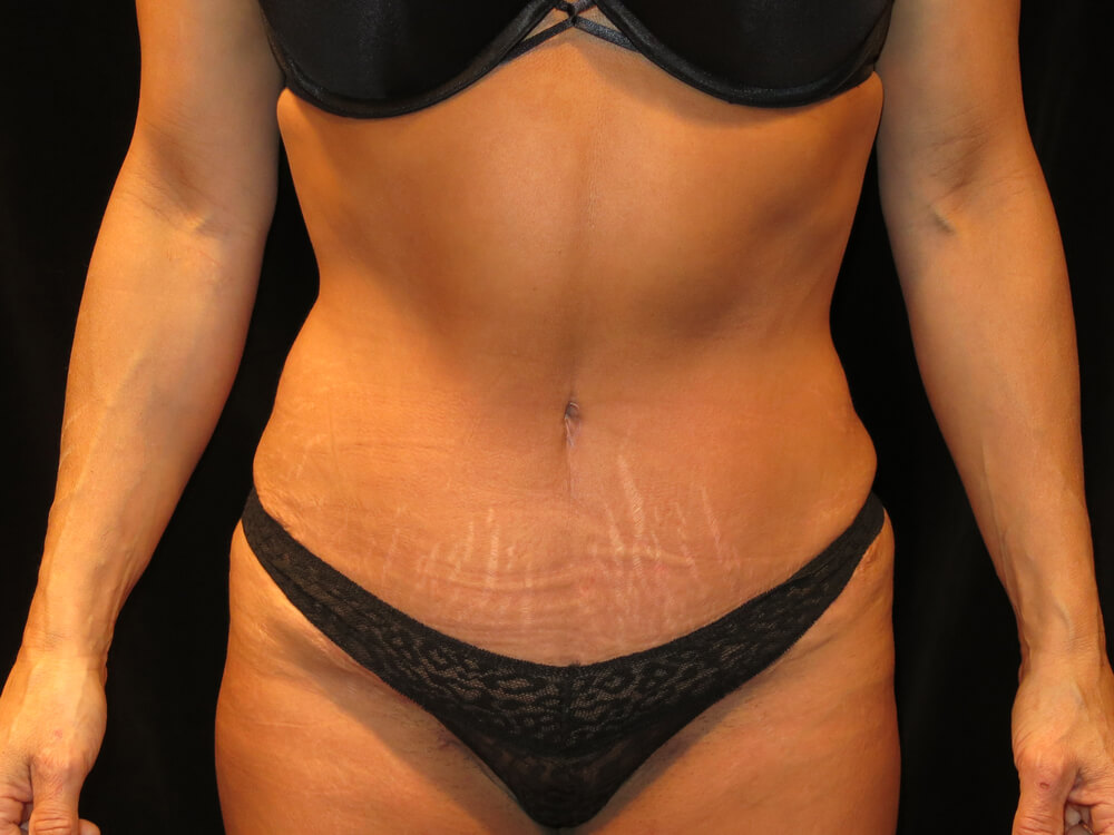 Tummy Tuck (abdominoplasty) - Dr. Joseph A. Racanelli Tummy Tuck (abdominoplasty)