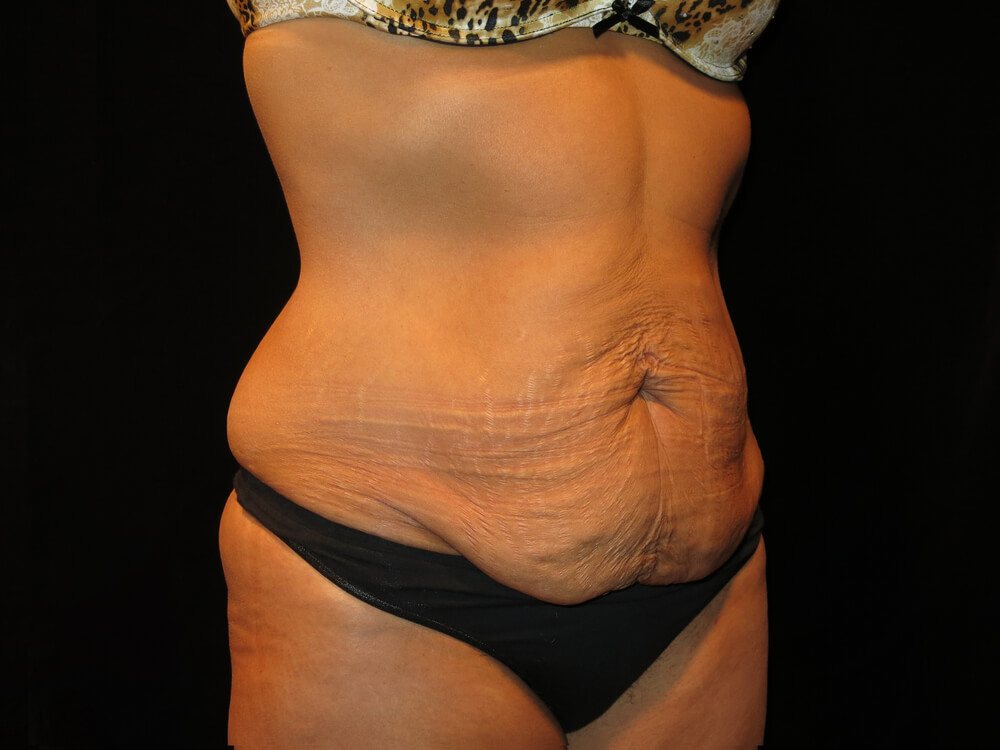 Tummy Tuck (abdominoplasty) - Dr. Joseph A. Racanelli Tummy Tuck (abdominoplasty)