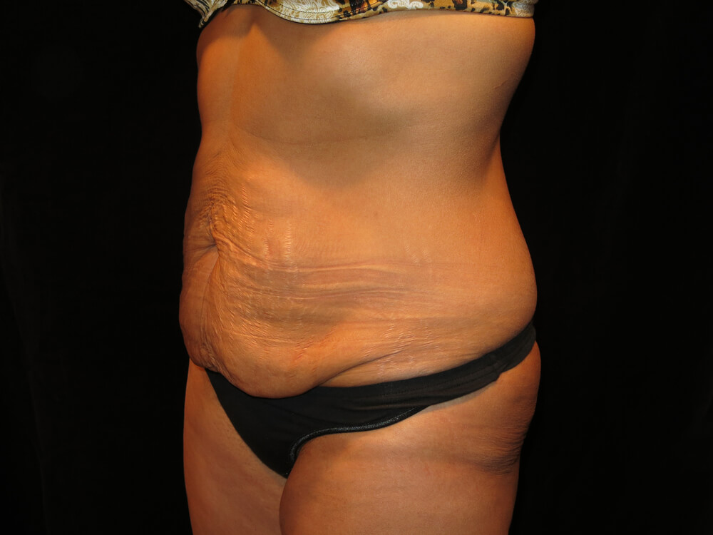 Tummy Tuck abdominoplasty 27g - Dr. Joseph A. Racanelli Tummy Tuck (abdominoplasty)