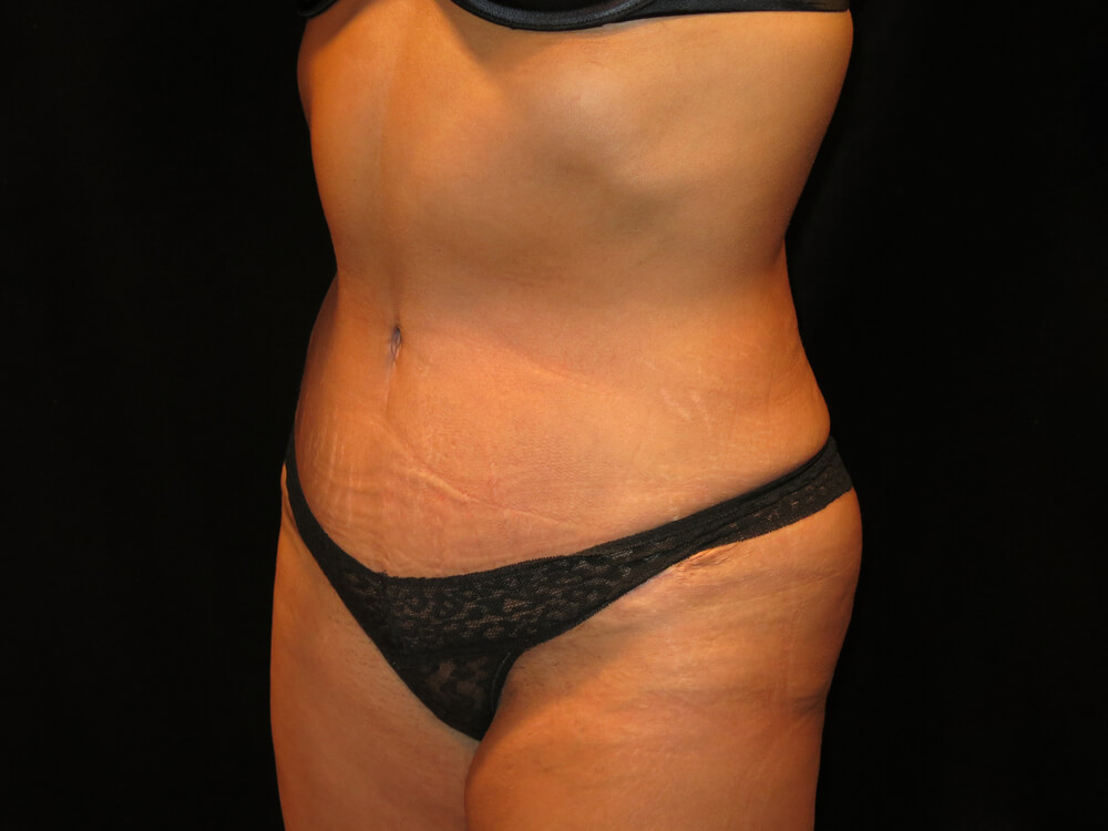 Tummy Tuck (abdominoplasty) - Dr. Joseph A. Racanelli Tummy Tuck (abdominoplasty)