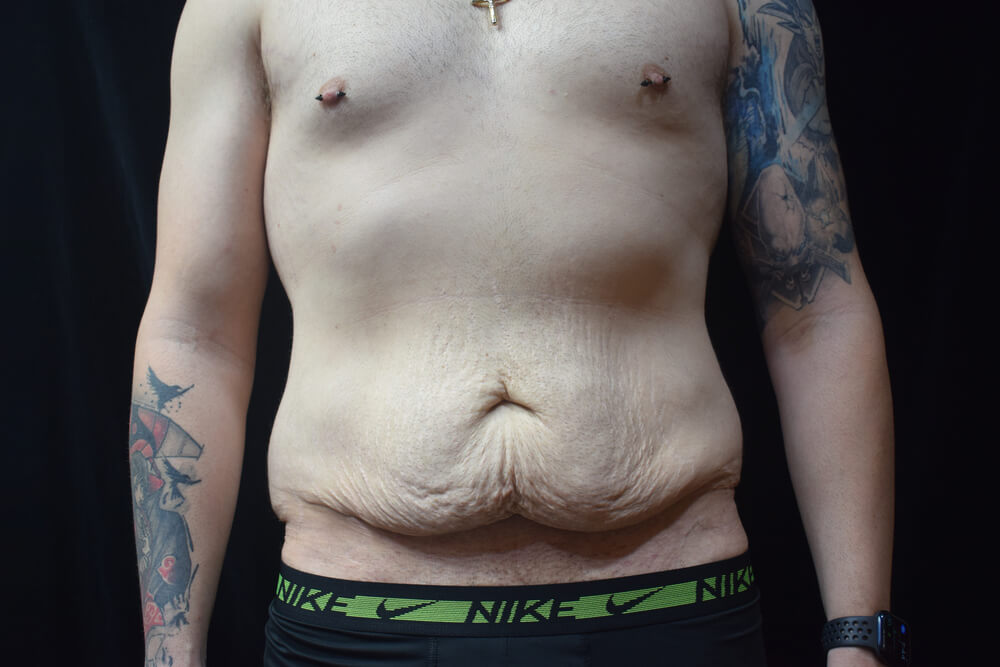 Tummy Tuck (abdominoplasty) - Dr. Joseph A. Racanelli Tummy Tuck (abdominoplasty)