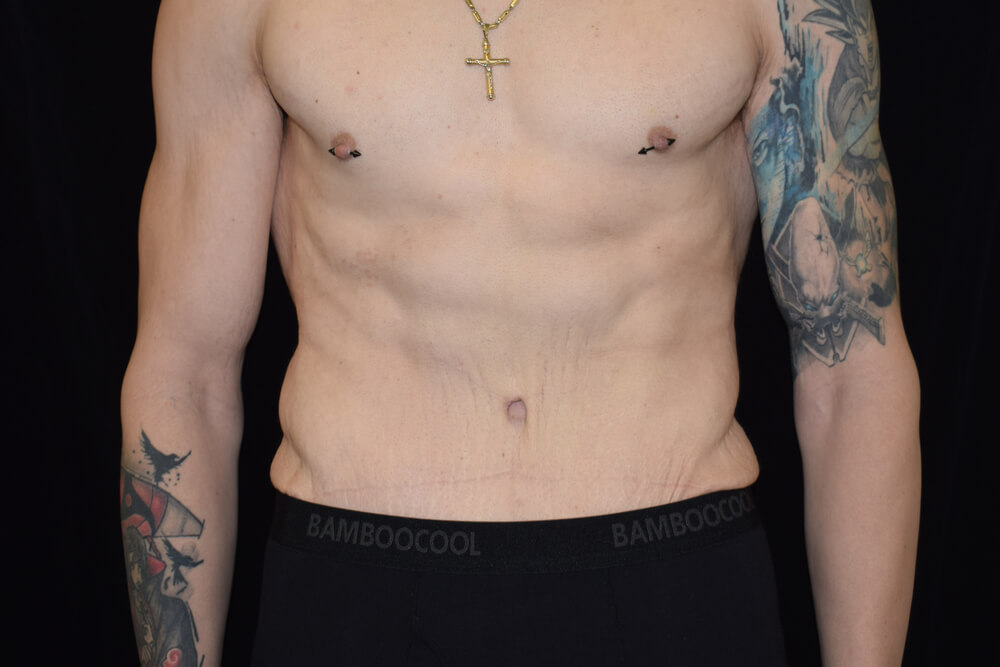 Tummy Tuck (abdominoplasty) - Dr. Joseph A. Racanelli Tummy Tuck (abdominoplasty)