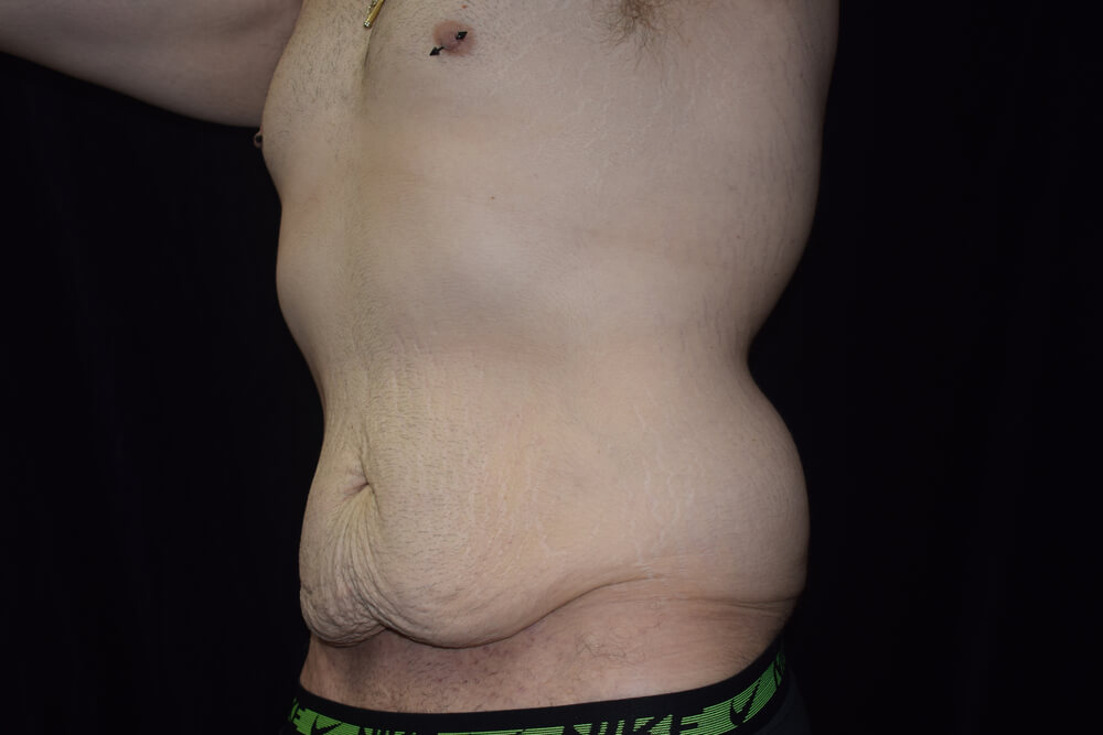 Tummy Tuck (abdominoplasty) - Dr. Joseph A. Racanelli Tummy Tuck (abdominoplasty)